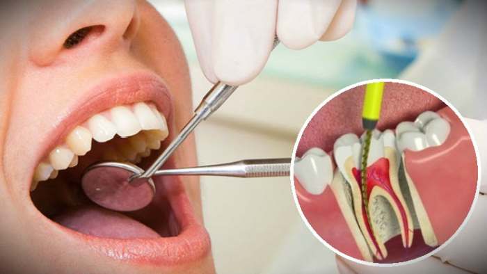 endodoncija-tb-dent-trebinje-min.jpg