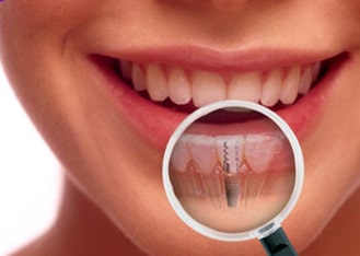 imlantologija-tb-dent-trebinje-min.jpg
