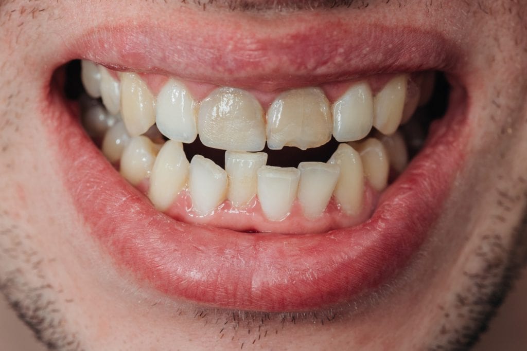 nepravilno-poredani-zubi-tb-dent-trebinje-1024x683-1-min.jpg