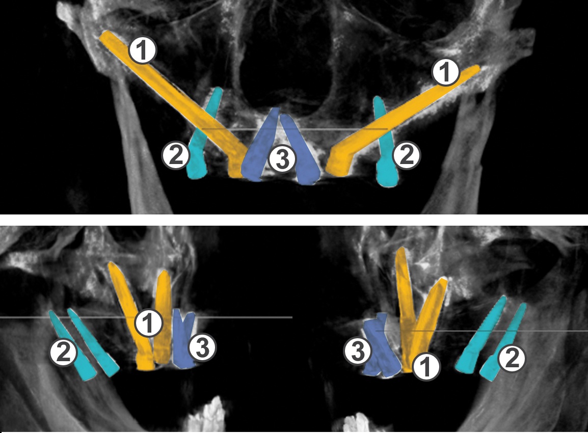 implantati nadazdin EHK copy.jpg